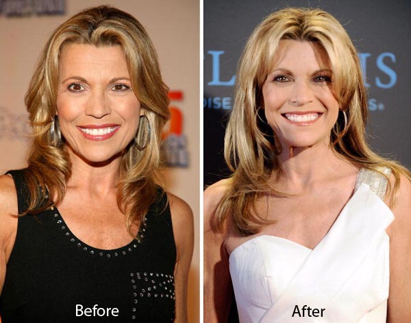 Vanna White Plastic Surgery Before & After