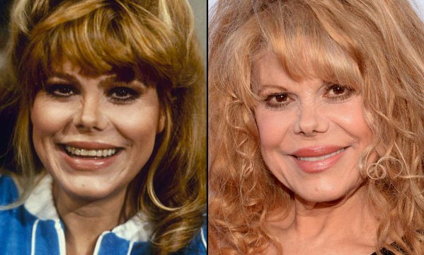 Charo Plastic Surgery Before & After