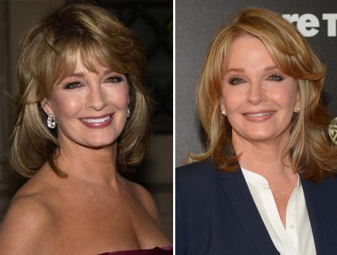 Deidre Hall Plastic Surgery Before & After