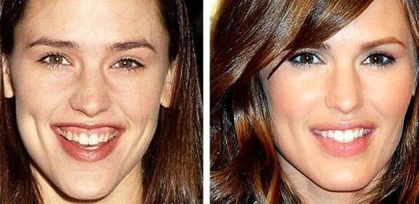 Jennifer Garner Plastic Surgery Before & After