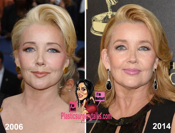 Melody Thomas Scott Plastic Surgery Before & After