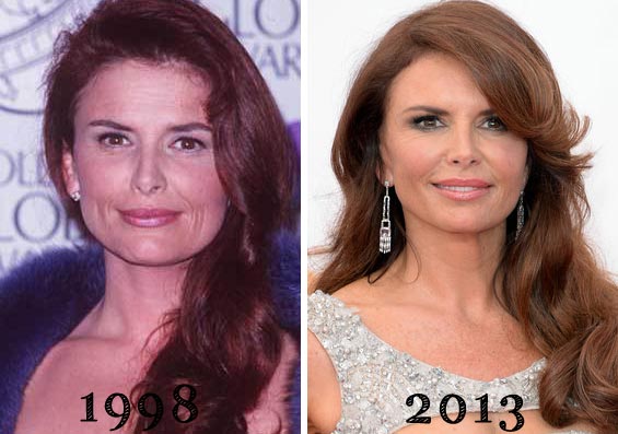 Roma Downey Plastic Surgery Before & After