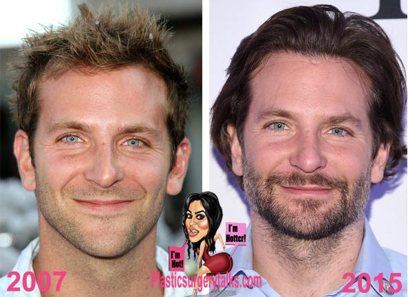 Bradley Cooper Plastic Surgery Before & After