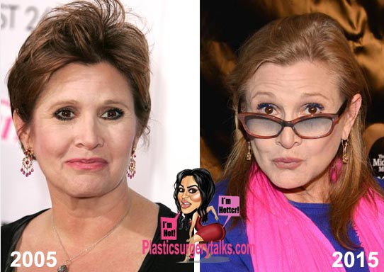 Carrie Fisher Plastic Surgery