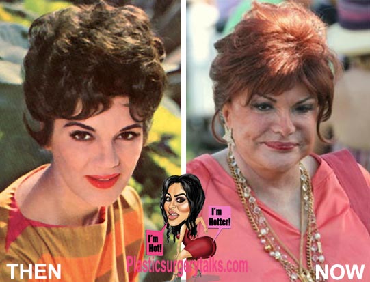 Connie Francis Plastic Surgery Before & After