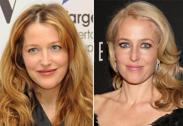 Gillian Anderson Plastic Surgery Before & After