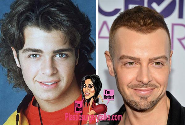 Joey Lawrence Plastic Surgery Before & After