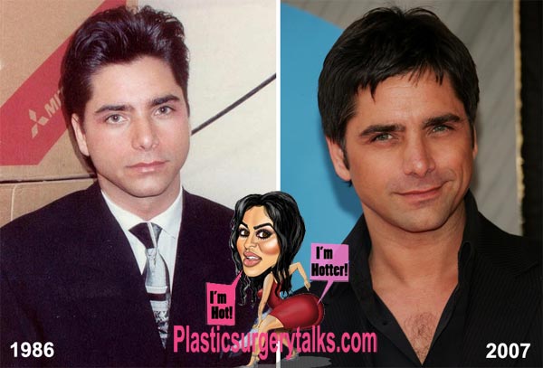 John Stamos Plastic Surgery Before & After