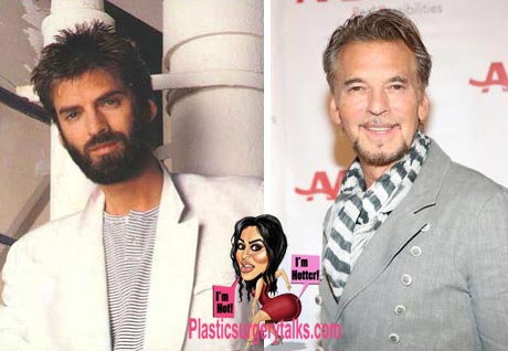 Kenny Loggins Plastic Surgery Before & After