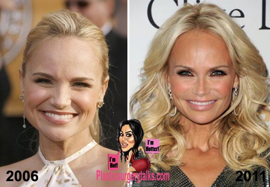 Kristin Chenoweth Plastic Surgery Before & After