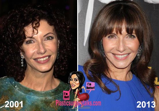 Mary Steenburgen Plastic Surgery Before & After