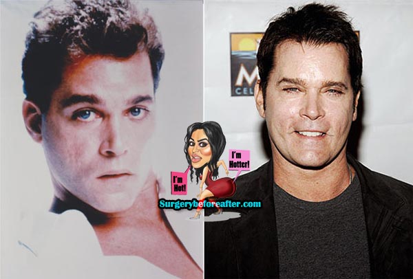Ray Liotta Plastic Surgery Before & After