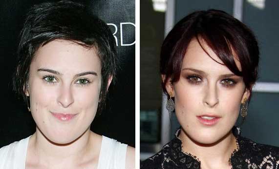 Rumer Willis Plastic Surgery Before & After