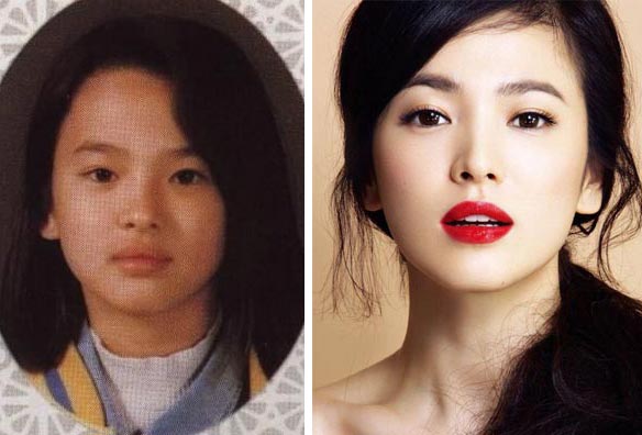Song Hye Kyo Plastic Surgery Before & After