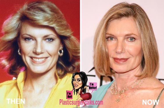 Susan Sullivan Plastic Surgery Before & After
