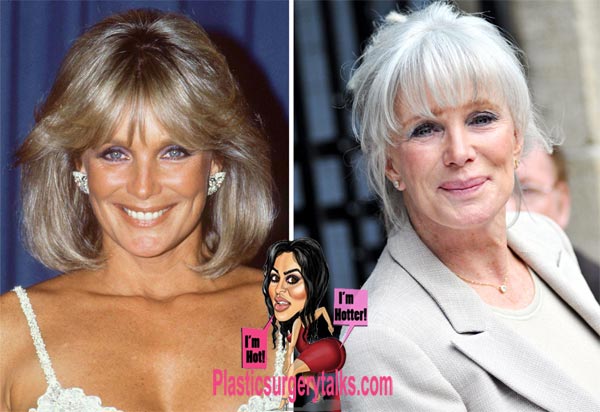 Linda Evans Plastic Surgery Before & After