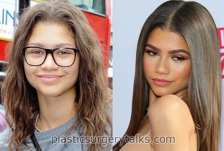 Zendaya Rhinoplasty